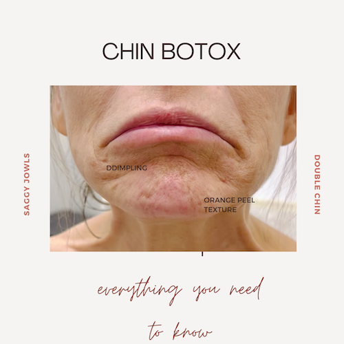 Everything You Want to Know About Botox for Your Chin